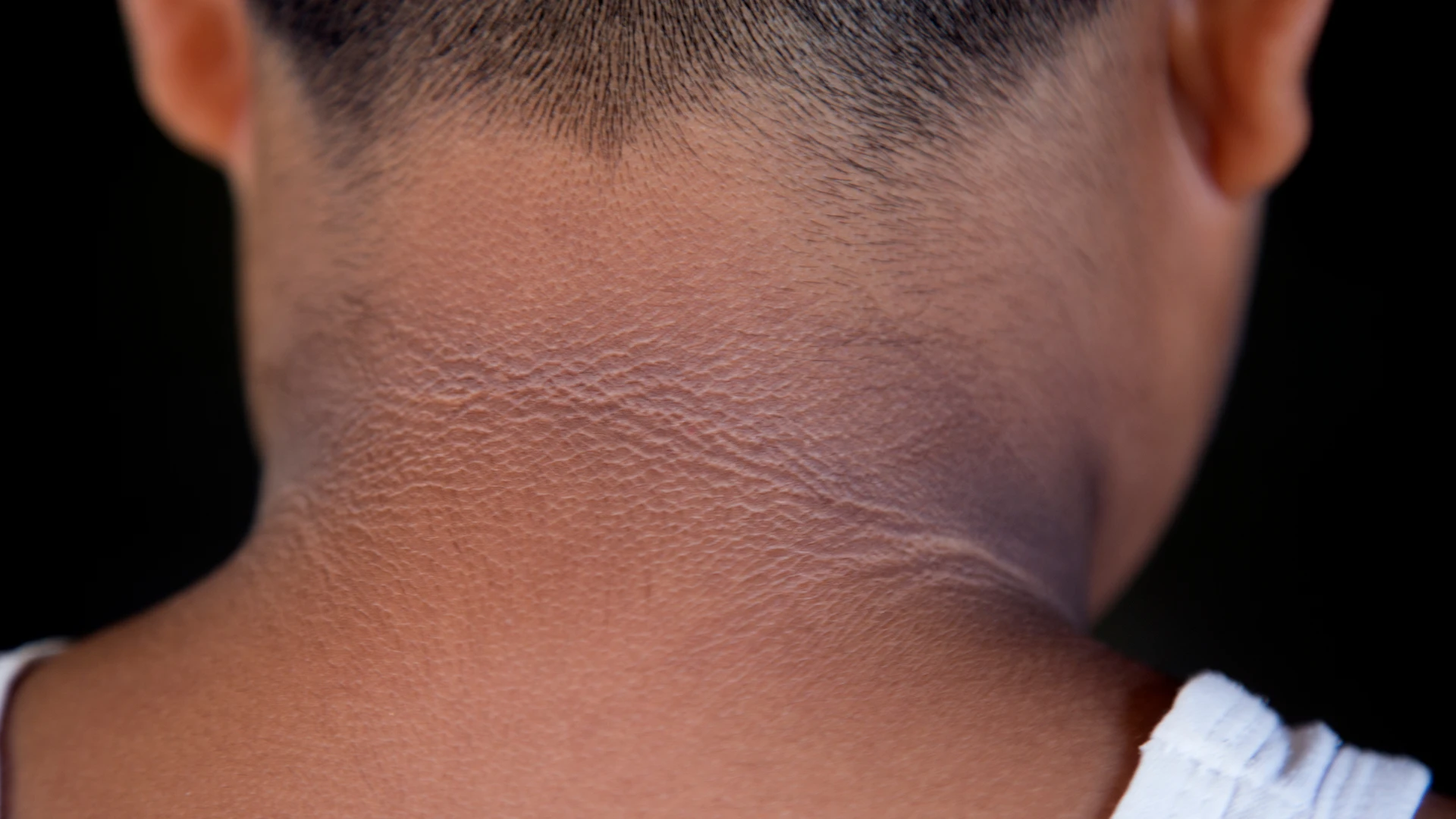 Imagem - Fique atento: manchas escuras no pescoço podem ser alerta de perigo à saúde