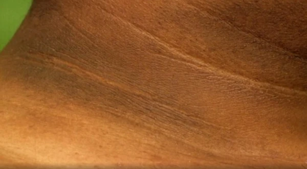 Manchas escuras no pescoço parecem sujeira, mas podem ser alerta de perigo à saúde