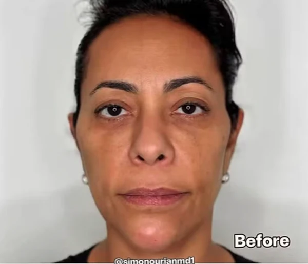 Humorista passou por procedimento na Califórnia por Reprodução | Redes Sociais