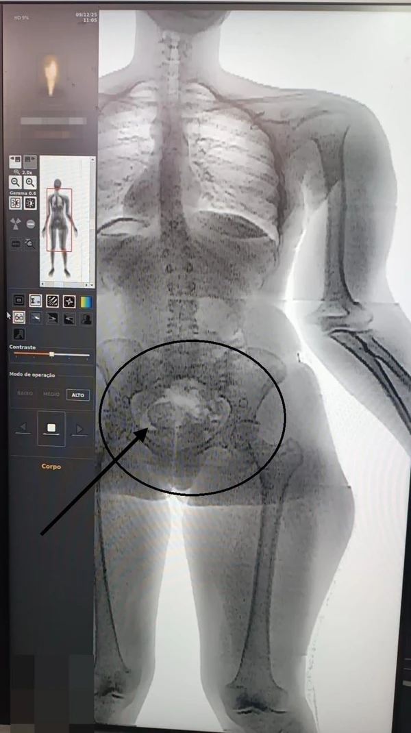 Mulher é flagrada pelo BodyScan tentando entrar com drogas nas partes íntimas na Cadeia Pública de Salvador por Divulgação/ SEAP