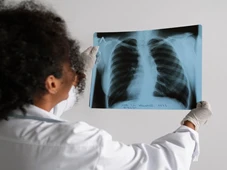 Imagem - Fique atento ao sinal inesperado que aparece nos dedos e que indicam que você tem câncer de pulmão