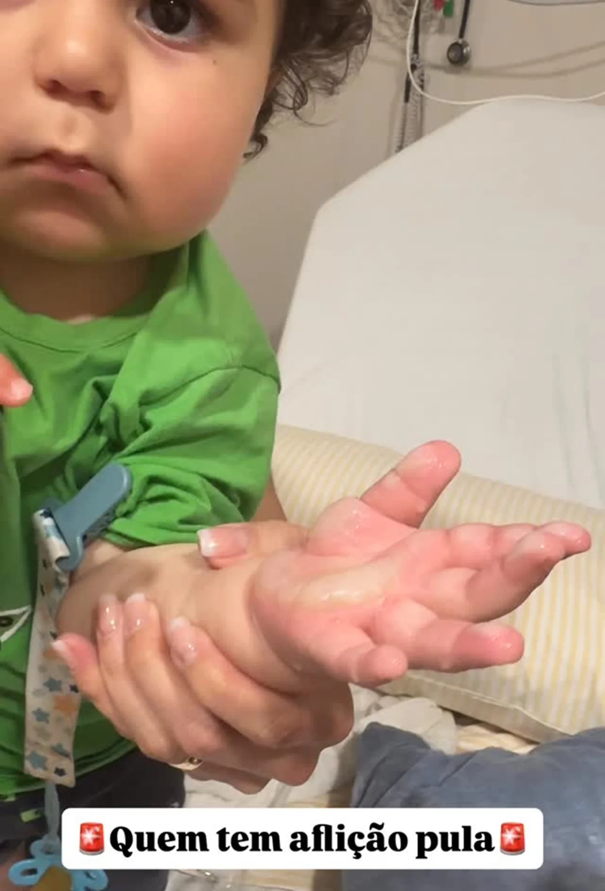 Por conta da gravidade da lesão, Ravi precisou passar por um procedimento cirúrgico chamado desbridamento, que consiste na retirada da pele queimada para evitar infecções e auxiliar na recuperação por Reprodução/Redes Sociais 