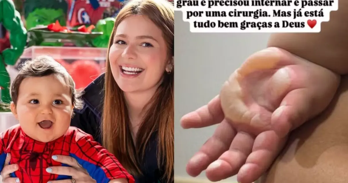 Ravi, de apenas 1 ano, sofreu uma queimadura de segundo grau na mão e precisou passar por uma cirurgia por Reprodução/Redes Sociais 