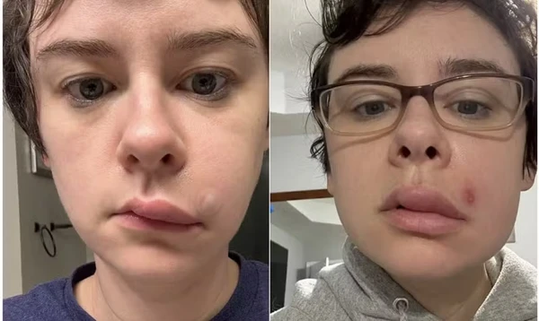 Lindsay de Oliveira espremeu espinha