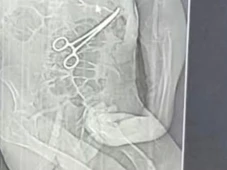 Imagem - Idoso morre após cirurgia e família denuncia instrumento esquecido no corpo em hospital