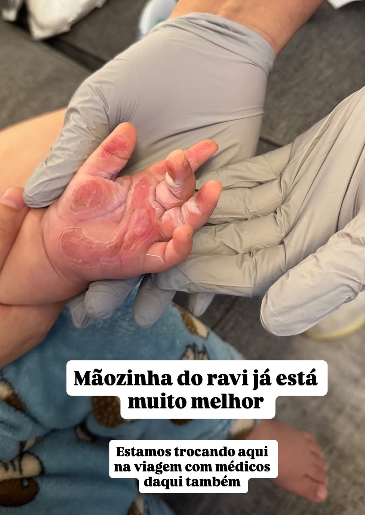 Queimadura de Ravi, filho de Viih Tube por Reprodução