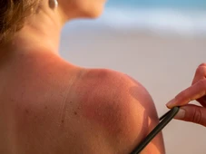 Imagem - Verão mais quente que o normal eleva risco de infecções de pele e acende alerta de especialistas