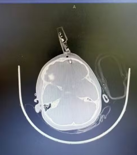 Criança cai e fica com carregador cravado na testa por Arquivo pessoal