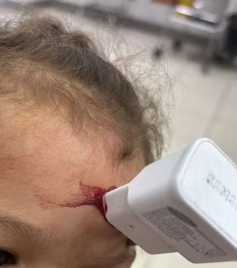 Criança cai e fica com carregador cravado na testa por Arquivo pessoal