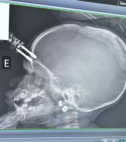 Criança cai e fica com carregador cravado na testa por Arquivo pessoal