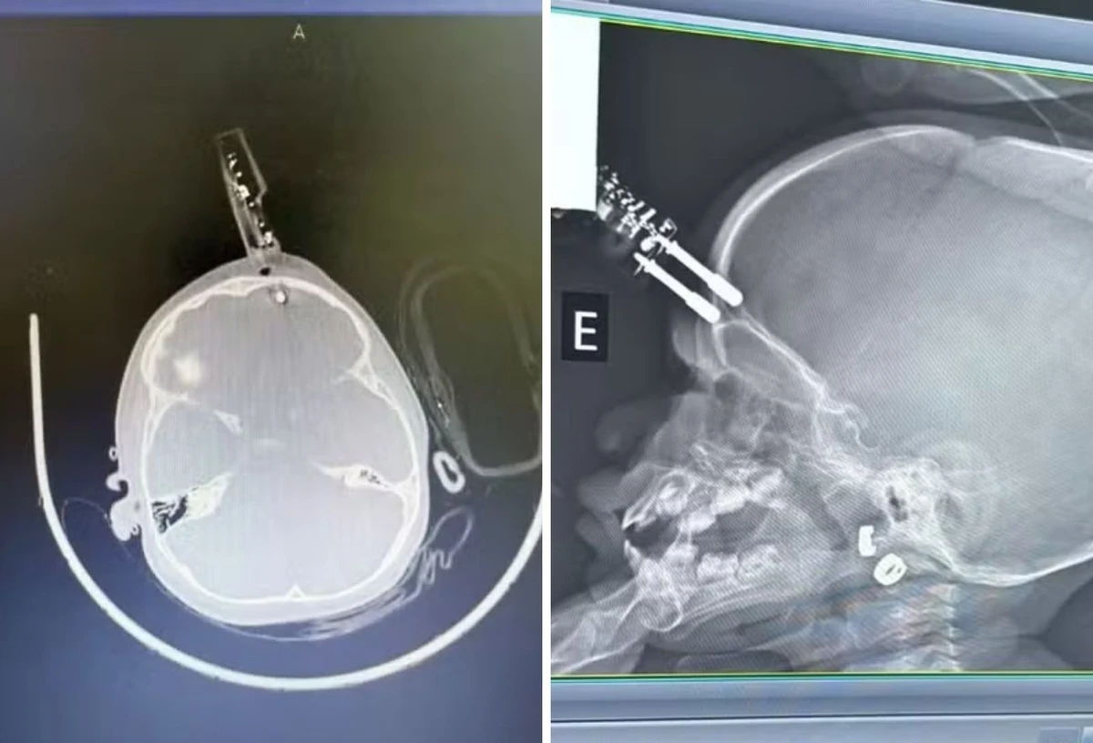 Exames mostram o aparelho que perfurou a a região frontal do crânio