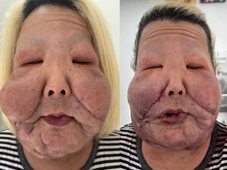 Imagem - Médico mostra óleo enrijecido retirado do rosto de Juju do Pix após nova cirurgia