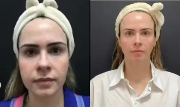 Ana Paula fez procedimentos estéticos no rosto um mês antes de entrar no 'BBB 26' por Reprodução/Redes Sociais 