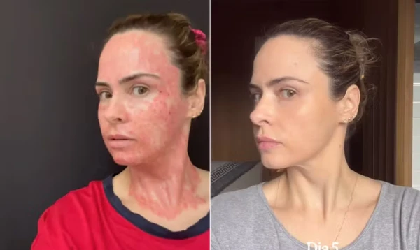 Ana Paula fez procedimentos estéticos no rosto um mês antes de entrar no 'BBB 26' por Reprodução/Redes Sociais 