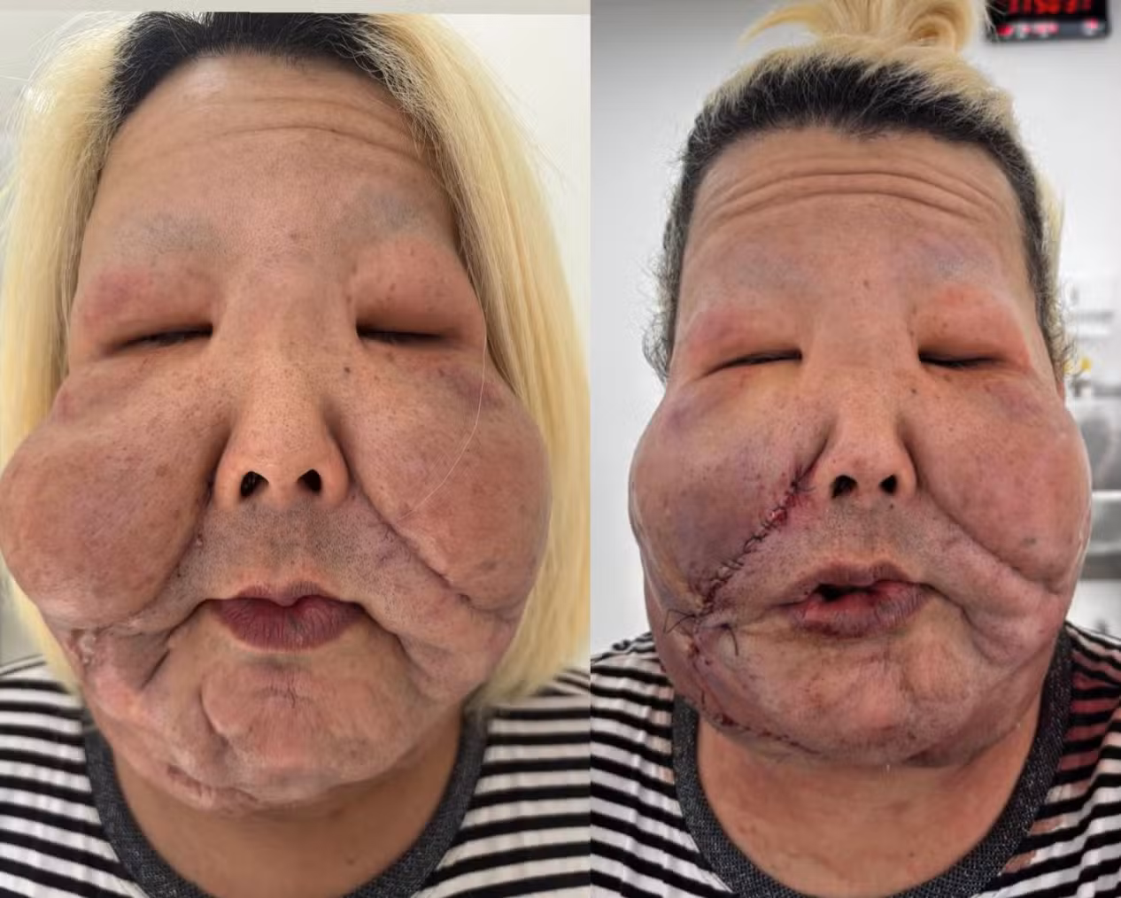 Juju do Pix antes e depois da cirurgia para retirada do óleo mineral enrijecido por Reprodução/Redes Sociais 