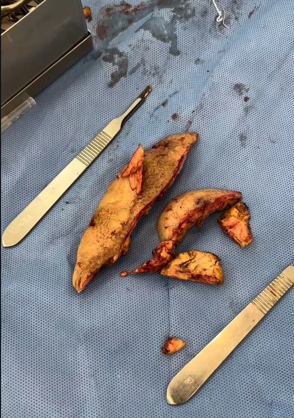 Médico mostra óleo mineral enrijecido retirado do rosto de Juju do Pix por Reprodução/Redes Sociais  