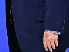 Imagem - Hematoma na mão de Trump chama atenção durante evento em Davos