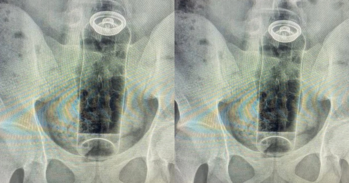 Imagem - Jovem de 19 anos é internado após introduzir desodorante no ânus