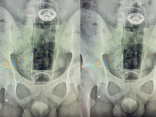 Imagem - Jovem de 19 anos é internado após introduzir desodorante no ânus