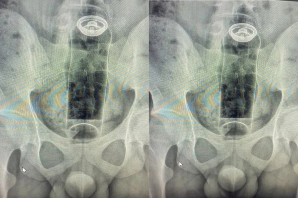 Imagens do desodorante no reto