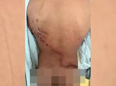 Imagem - Jovem teve costas rasgadas por raio em ato de Nikolas: 'Achei que tinha 1h de vida'