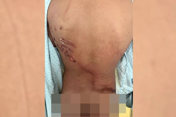 Jovem teve costas rasgadas por raio em ato de Nikolas: 'Achei que tinha 1h de vida'