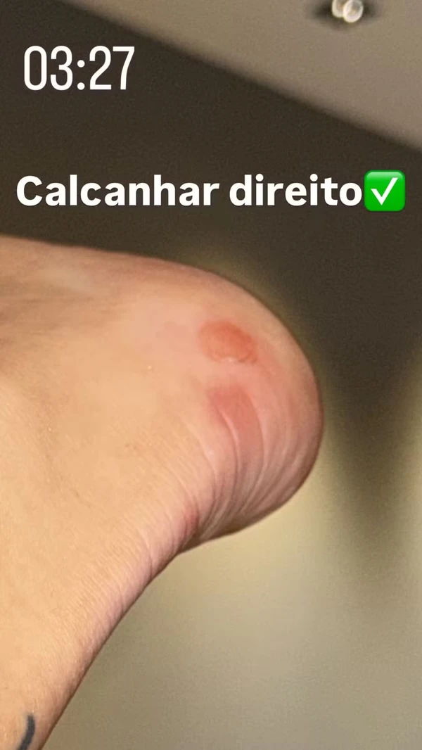 Virginia exibe galo na testa e machucados após ensaio da Grande Rio por Reprodução/Redes Sociais 