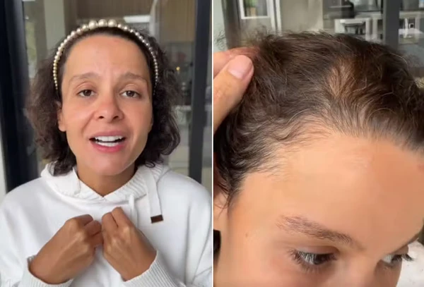 Maiara, dupla de Maraisa, relata trauma com a queda de cabelo por Reprodução/Redes Sociais 
