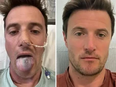 Imagem - Homem quase perde a língua por causa do HPV: 'Não sabia que poderia causar câncer em homens'