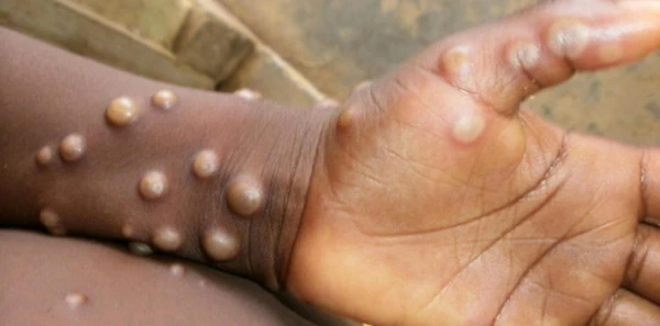 Monkeypox por Centers for Disease Control and Prevention / Divulgação