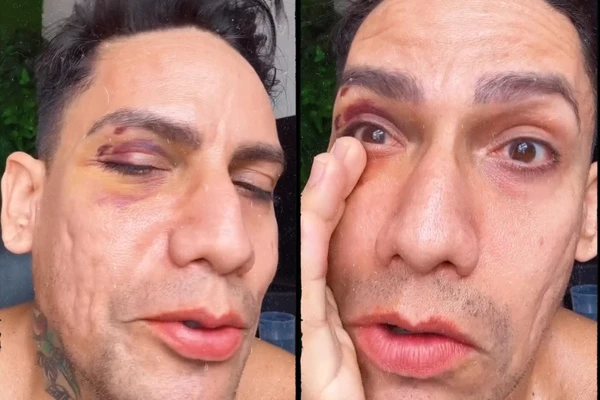 Arquiteto é agredido por grupo de jovens após se vestir como drag queen no Carnaval: 'Levei um soco'