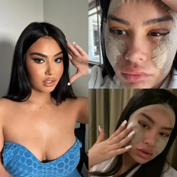 Júlia Medeiros passou por cirurgia estética por @juju.brazil | CO ASSESSORIA