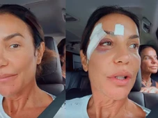 Imagem - Com olho roxo após desmaiar, Ivete Sangalo comemora alta hospitalar
