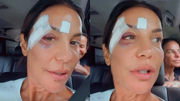 Ivete Sangalo mostrou o olho roxo em vídeo nas redes sociais
