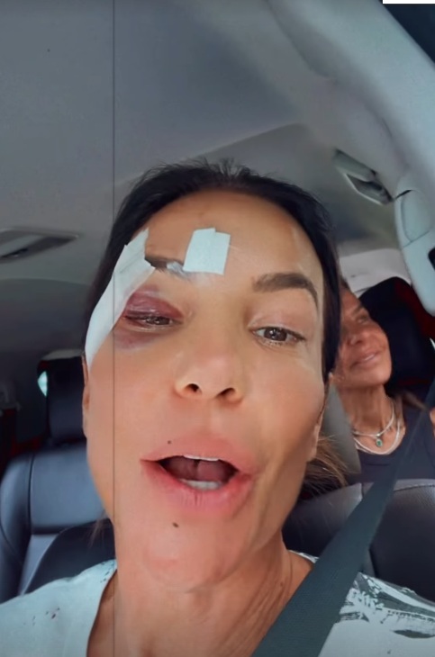 Ivete surgiu com olho roxo e comemorou a alta médica por Reprodução/Instagram