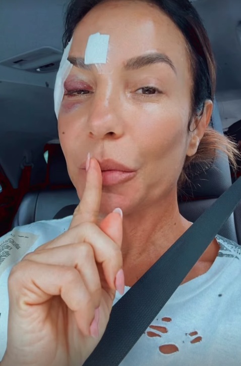 Ivete surgiu com olho roxo e comemorou a alta médica por Reprodução/Instagram