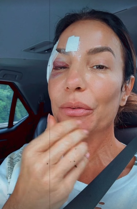 Ivete surgiu com olho roxo e comemorou a alta médica por Reprodução/Instagram