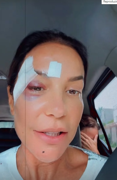 Ivete surgiu com olho roxo e comemorou a alta médica por Reprodução/Instagram