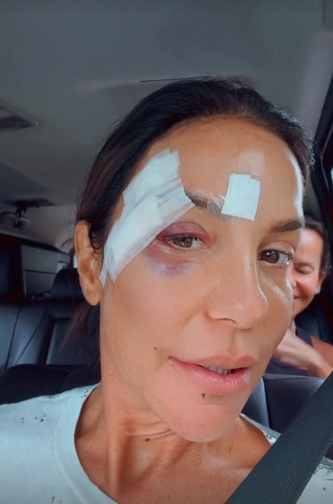 Ivete surgiu com olho roxo e comemorou a alta médica por Reprodução/Instagram