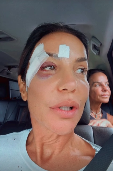 Ivete surgiu com olho roxo e comemorou a alta médica por Reprodução/Instagram