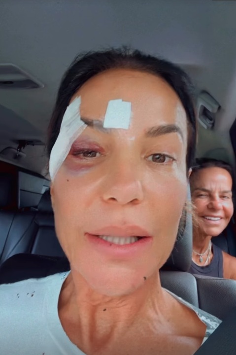 Ivete surgiu com olho roxo e comemorou a alta médica por Reprodução/Instagram