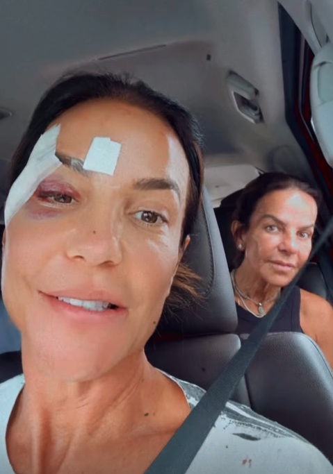 Ivete surgiu com olho roxo e comemorou a alta médica por Reprodução/Instagram