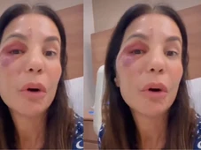 Imagem - Ivete Sangalo quebra silêncio após cirurgia delicada no rosto: ‘Poderia ter sido muito pior’