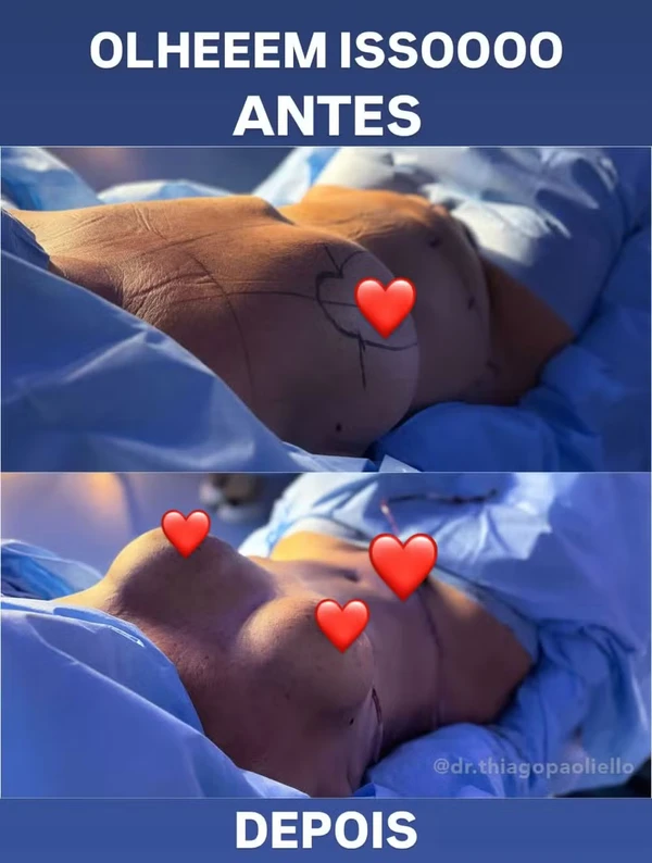 Corpo de Margareth Serrão após procedimentos por Reprodução/Instagram