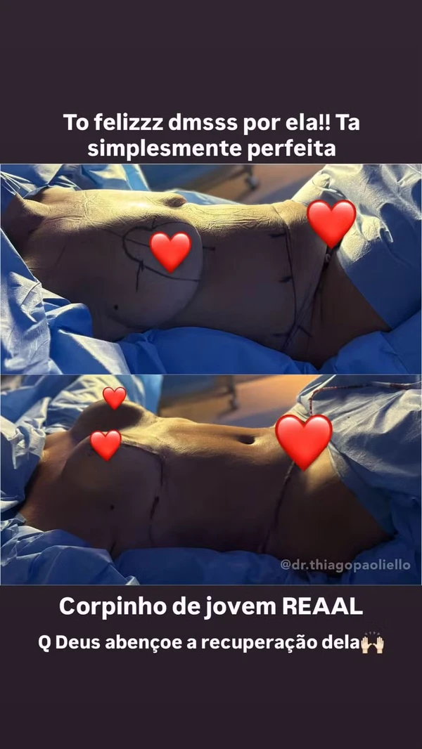 Corpo de Margareth Serrão após procedimentos por Reprodução/Instagram