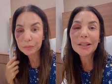 Imagem - Ivete Sangalo recebe alta após cirurgia no rosto e manda recado aos fãs: 'Tô ótima'