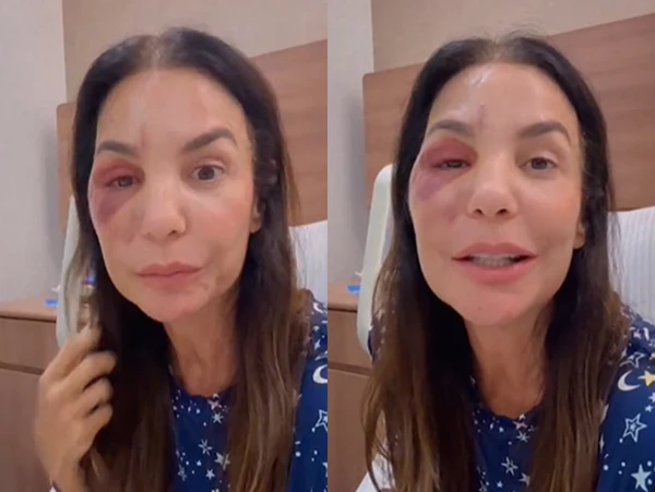 Após cirurgia na face, Ivete Sangalo celebra alta médica