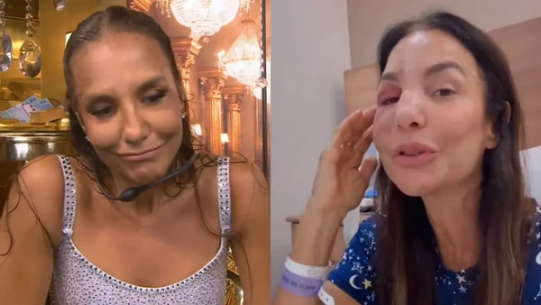 Ivete Sangalo após operar o rosto por Reprodução