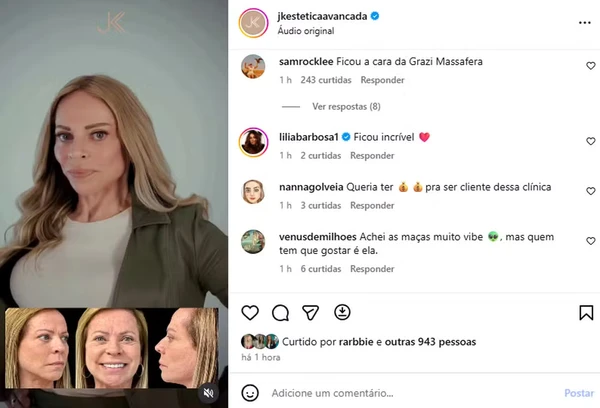 Christina Rocha aparece com 'novo rosto' após procedimento estético por  Reprodução/Instagram/JK Estética