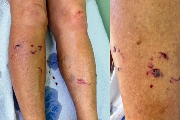 Raposa ataca mulher durante caminhada na Bahia; três pessoas já foram vítimas